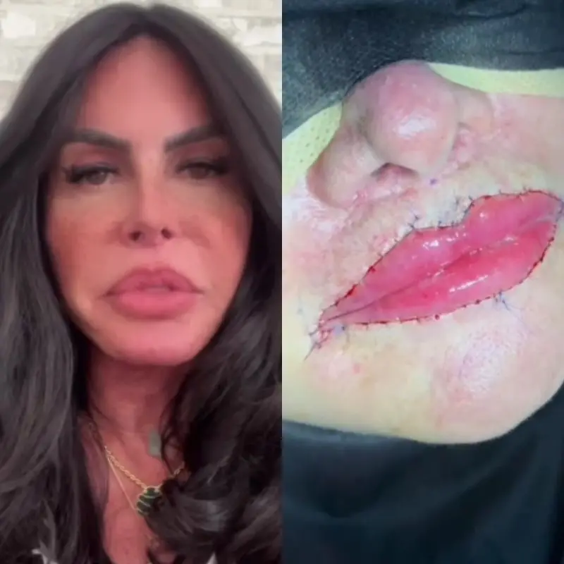 Imagem da notícia Gretchen reverte procedimento estético e remove PMMA dos lábios