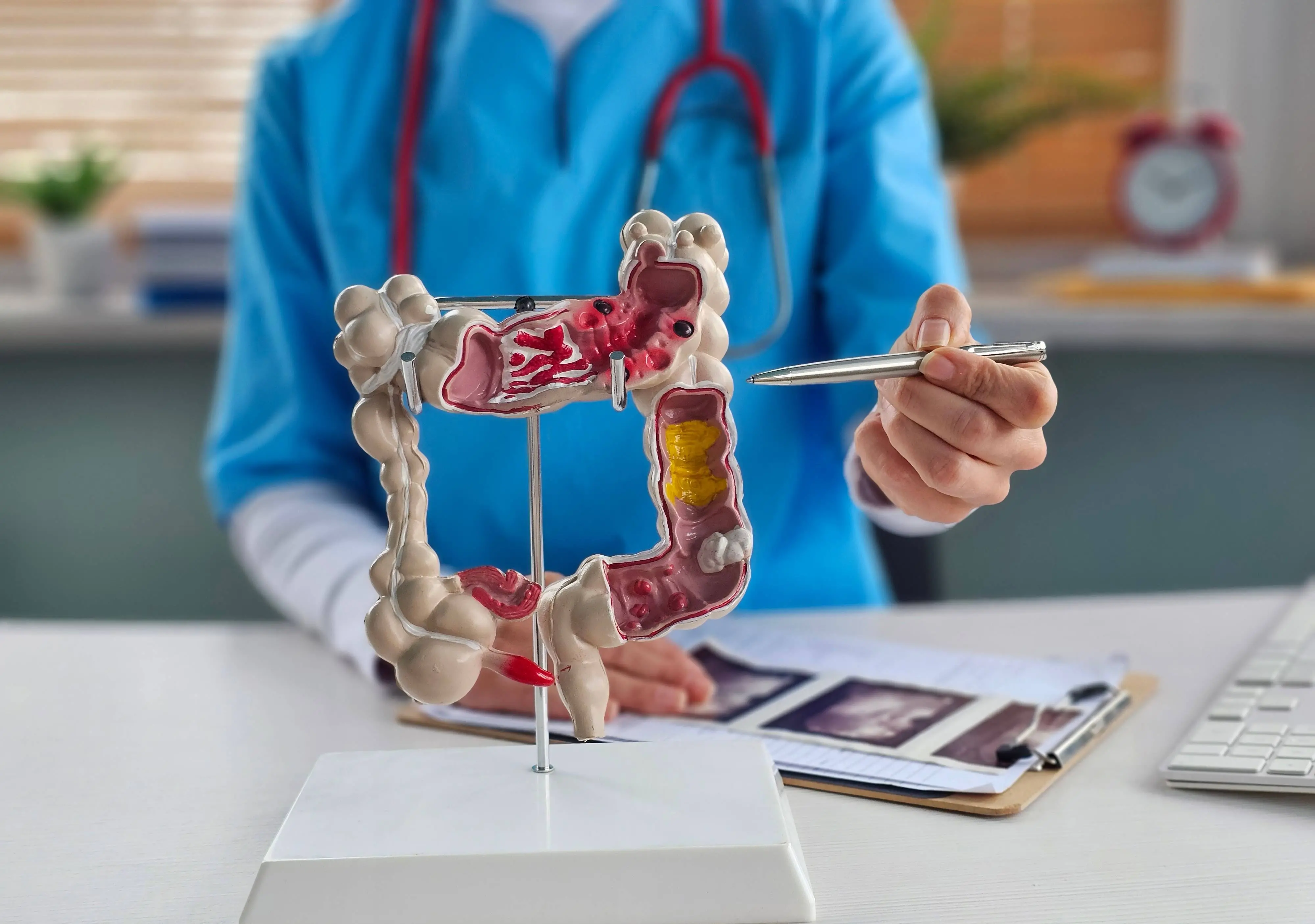 A imagem mostra uma pessoa, provavelmente um médico ou profissional de saúde, vestindo um jaleco azul e um estetoscópio. A pessoa está apontando com uma caneta para um modelo anatômico detalhado do cólon humano, que está seccionado para mostrar a estrutura interna. O modelo destaca uma seção com o que parece ser um tumor maligno ou uma área de doença, possivelmente representando câncer colorretal. Há também uma prancheta com papéis sobre uma mesa à frente. O fundo é um cenário de consultório médico.