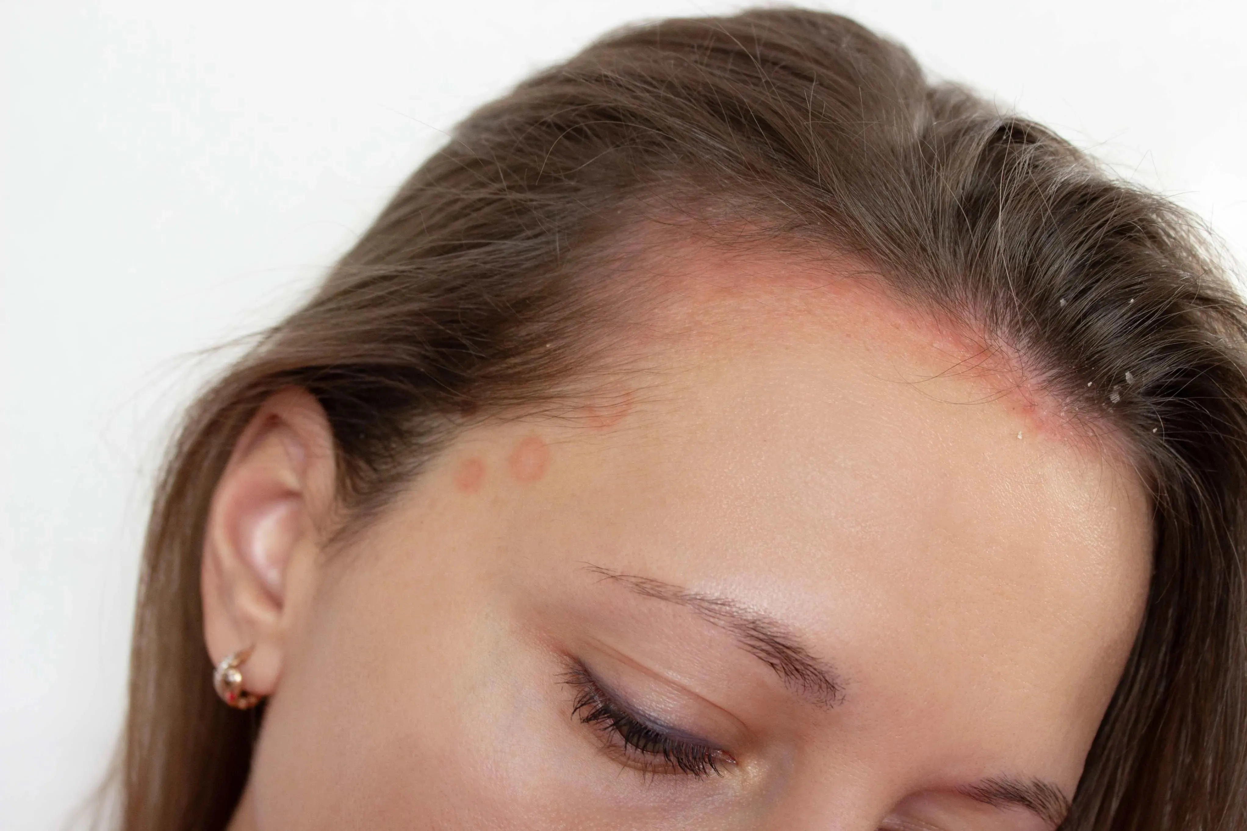 Caso o paciente apresente descamação e vermelhidão do couro cabeludo, a especialista recomenda buscar um médico dermatologista