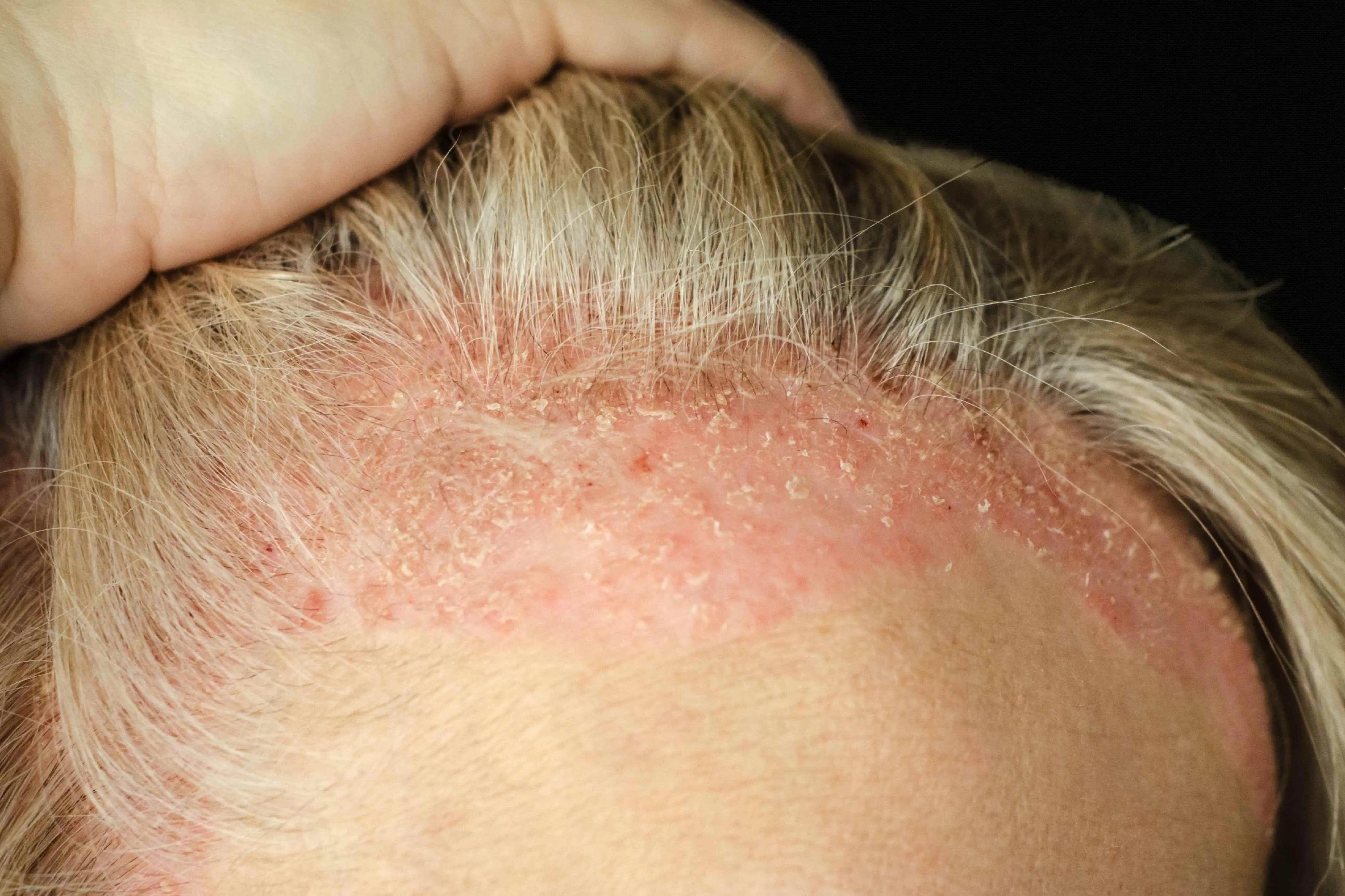 Imagem de um couro cabeludo descascando, para matéria sobre coceira na cabeça, o que pode ser? Veja causas comuns e quando procurar ajuda