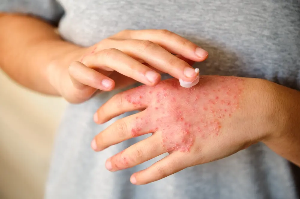 Imagem da notícia: Dia da Dermatite Atópica: saiba causas, o que agrava e como tratar