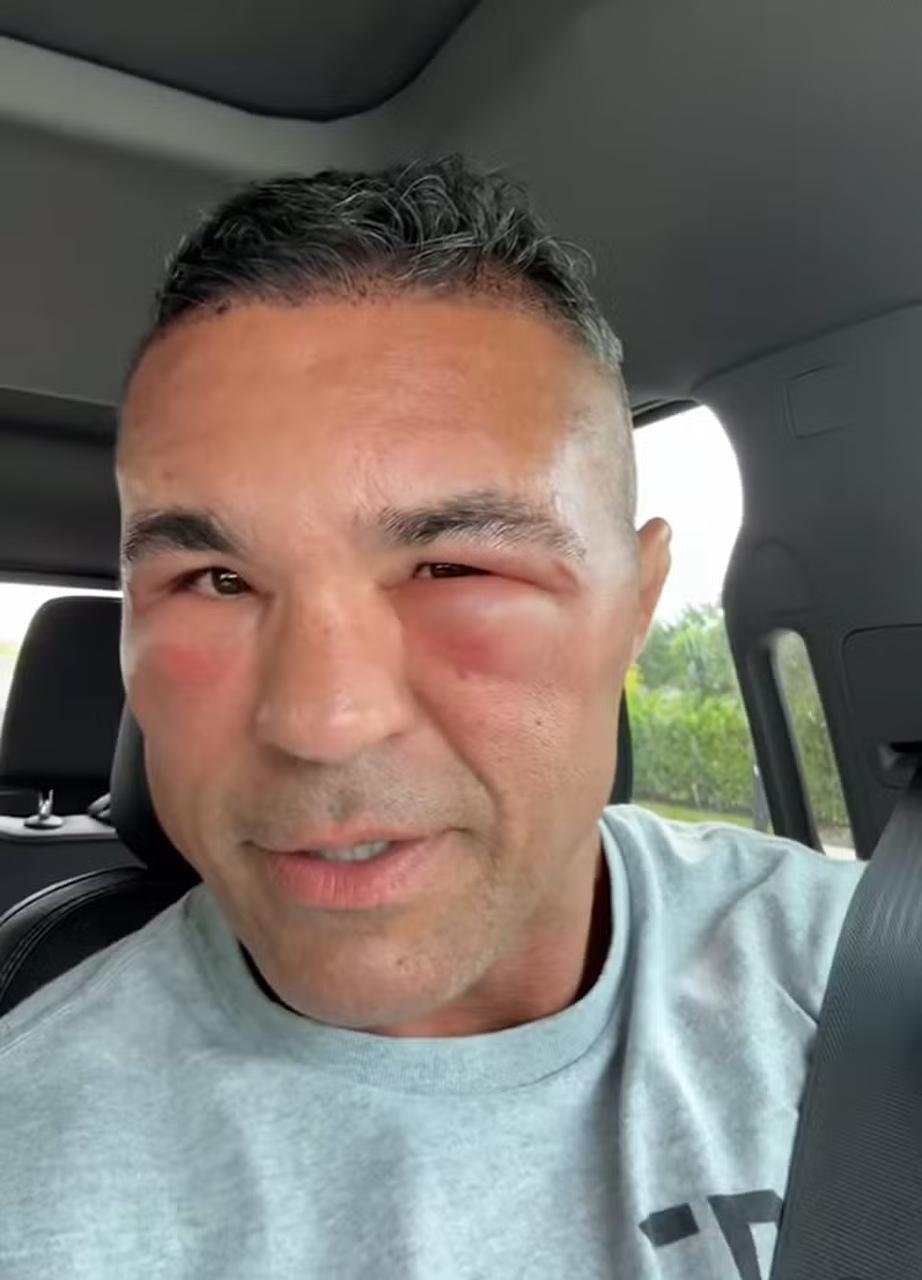 Vitor Belfort aparece com o rosto inchado