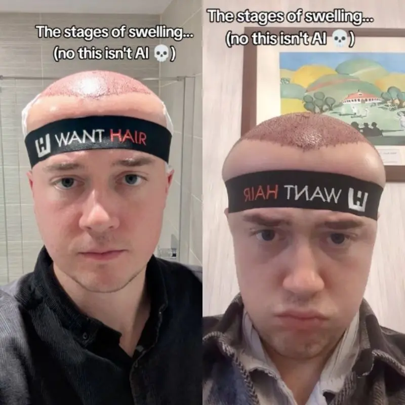 montagem com fotos de Britânico que viralizou no TikTok ao mostrar o pós-operatório de um transplante capilar.