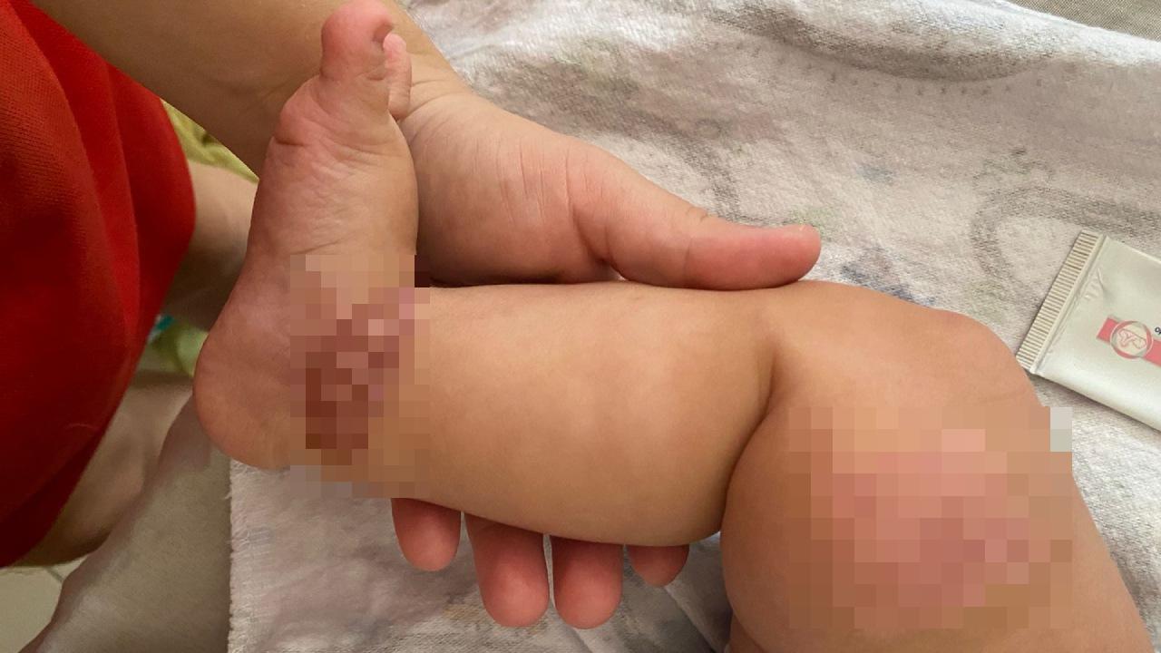 Cicatrizes de necrose na perna e pé de um bebê após complicação médica.