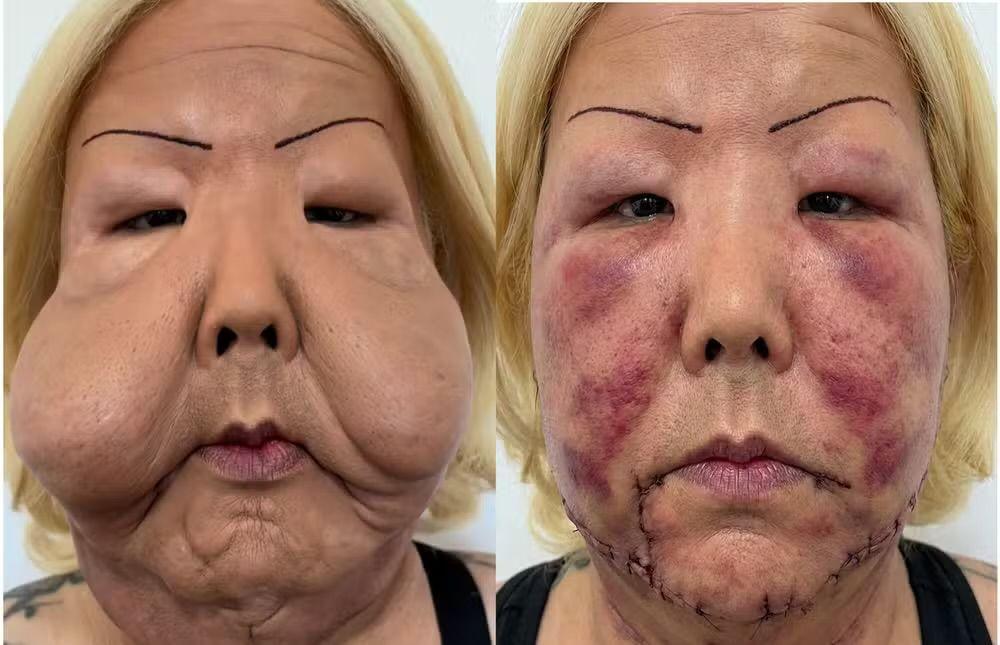 Juju do Pix retirou o óleo mineral que deformou seu rosto.