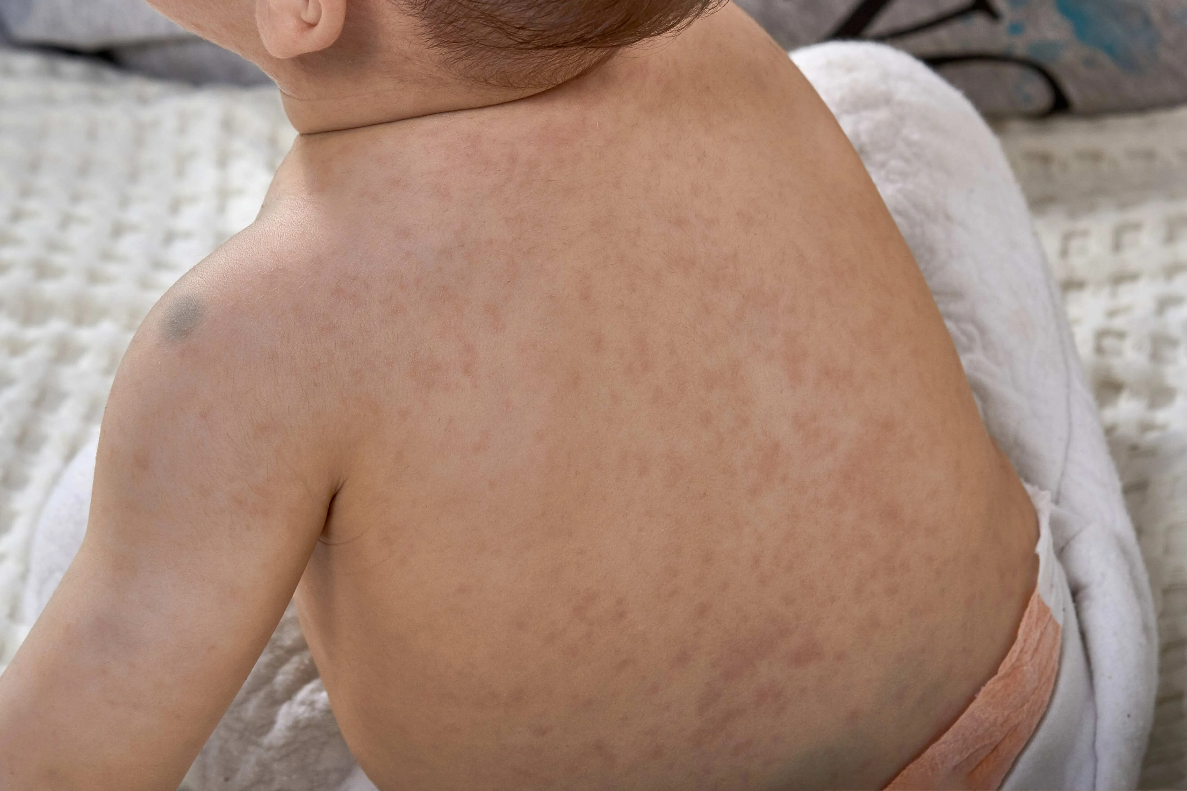 A presença de manchas no corpo pode ser um dos indicativos da meningite.