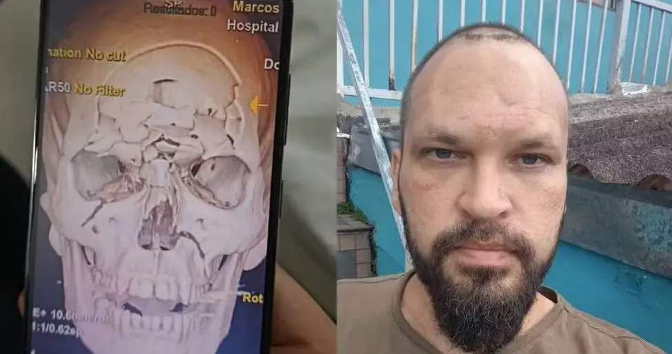 Imagem dividida: à esquerda, uma tomografia 3D de um crânio humano com fraturas; à direita, um close do rosto de um homem barbudo e careca.
