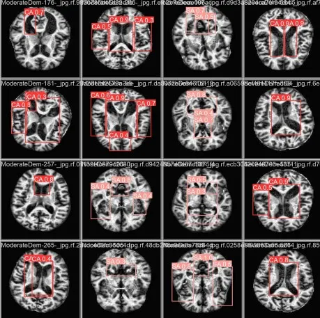 Conjunto de imagens de ressonância magnética cerebral, mostrando diferentes seções e angulações do cérebro humano.