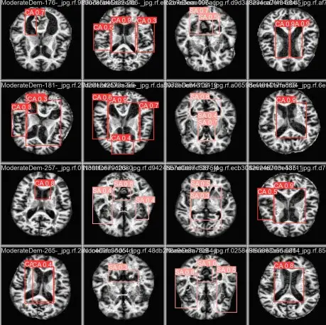 Imagem mostra cérebro visto por meio de exame de ressonância magnética.