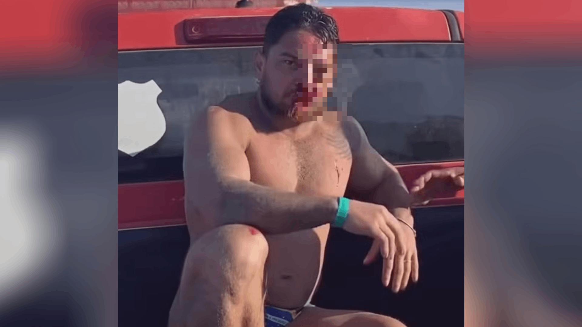 Imagem de uma das vítimas que precisaram receber atendimento médico.