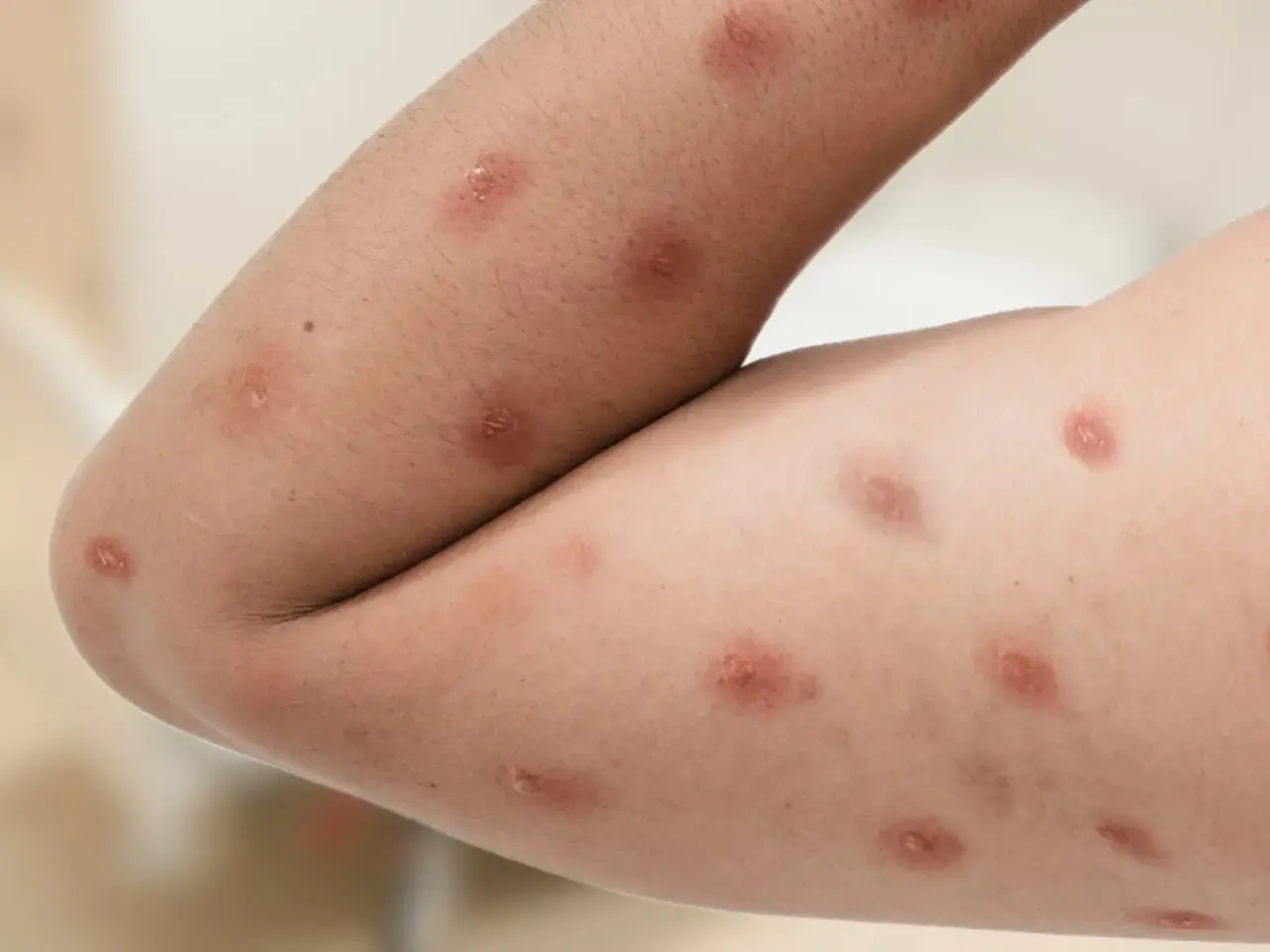 Pessoa com erupções na pele, sintoma da doença Mpox. Imagem usada em matéria sobre o primeiro caso de 2026 em Porto Alegre.