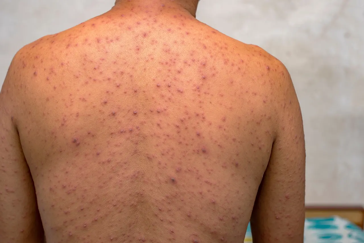 Imagem mostra, em close-up, um homem de costas com lesões de mpox, varíola dos macacos ou monkey pox.