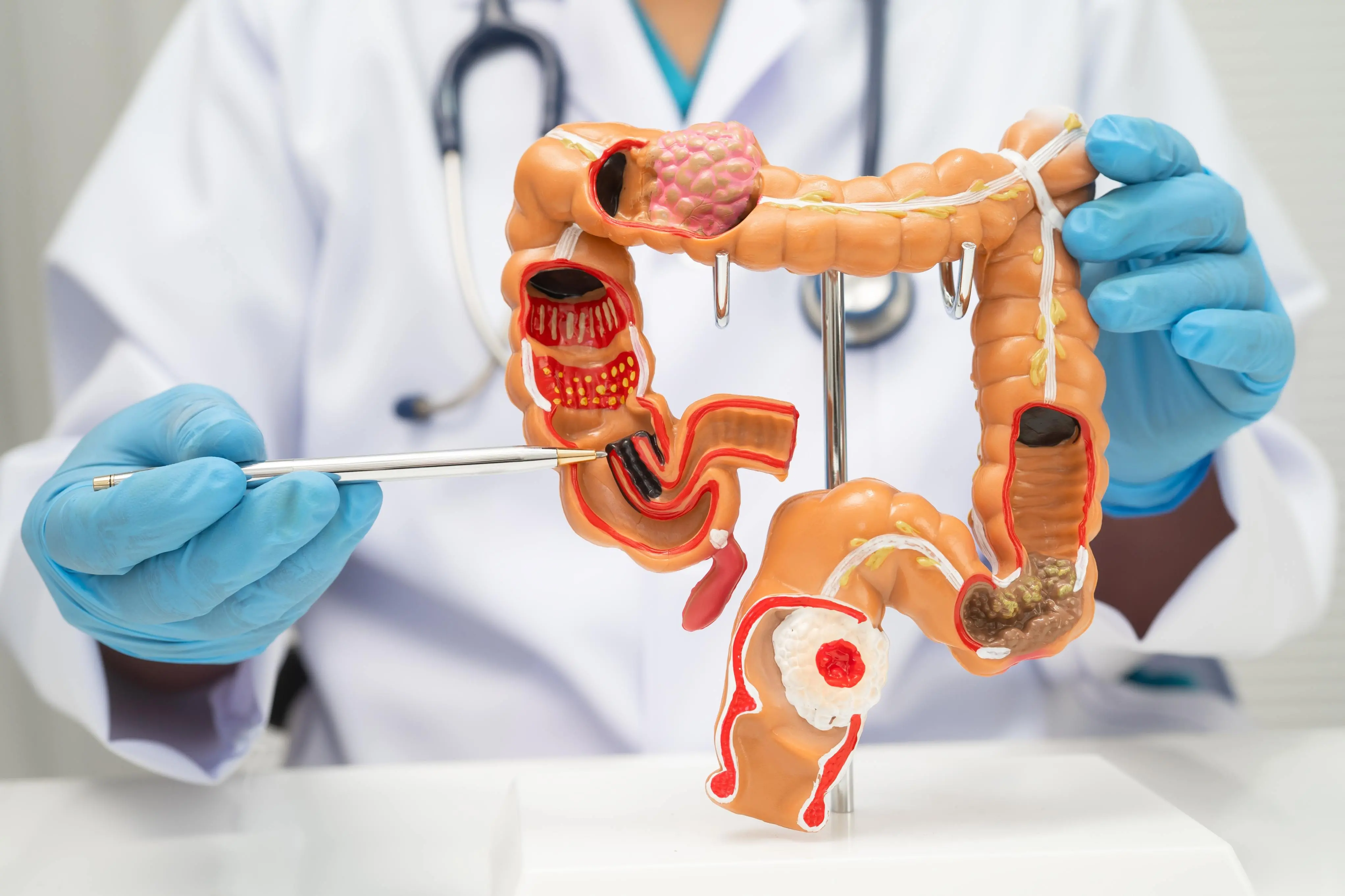 Imagem de câncer de colorretal para evergreen sobre a temática.