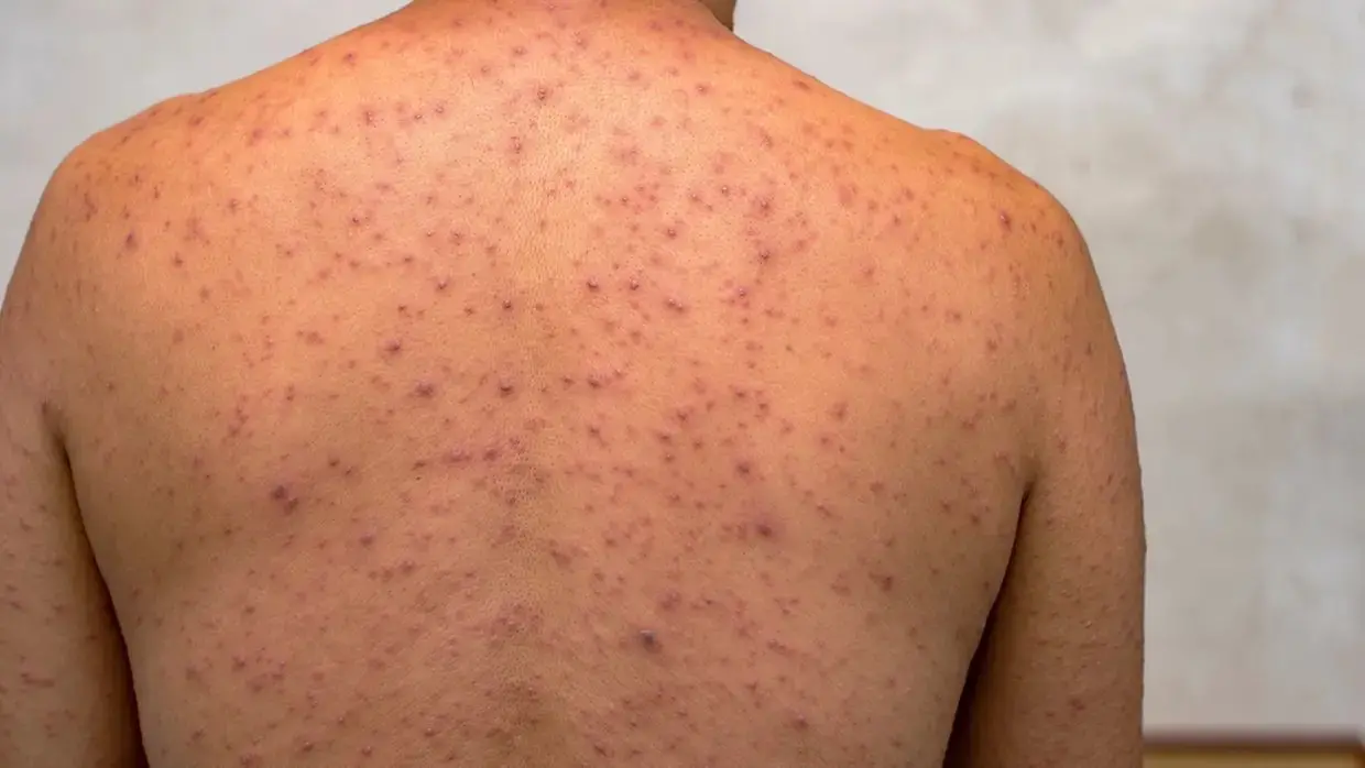 Foto de pessoas com sinais de Mpox.