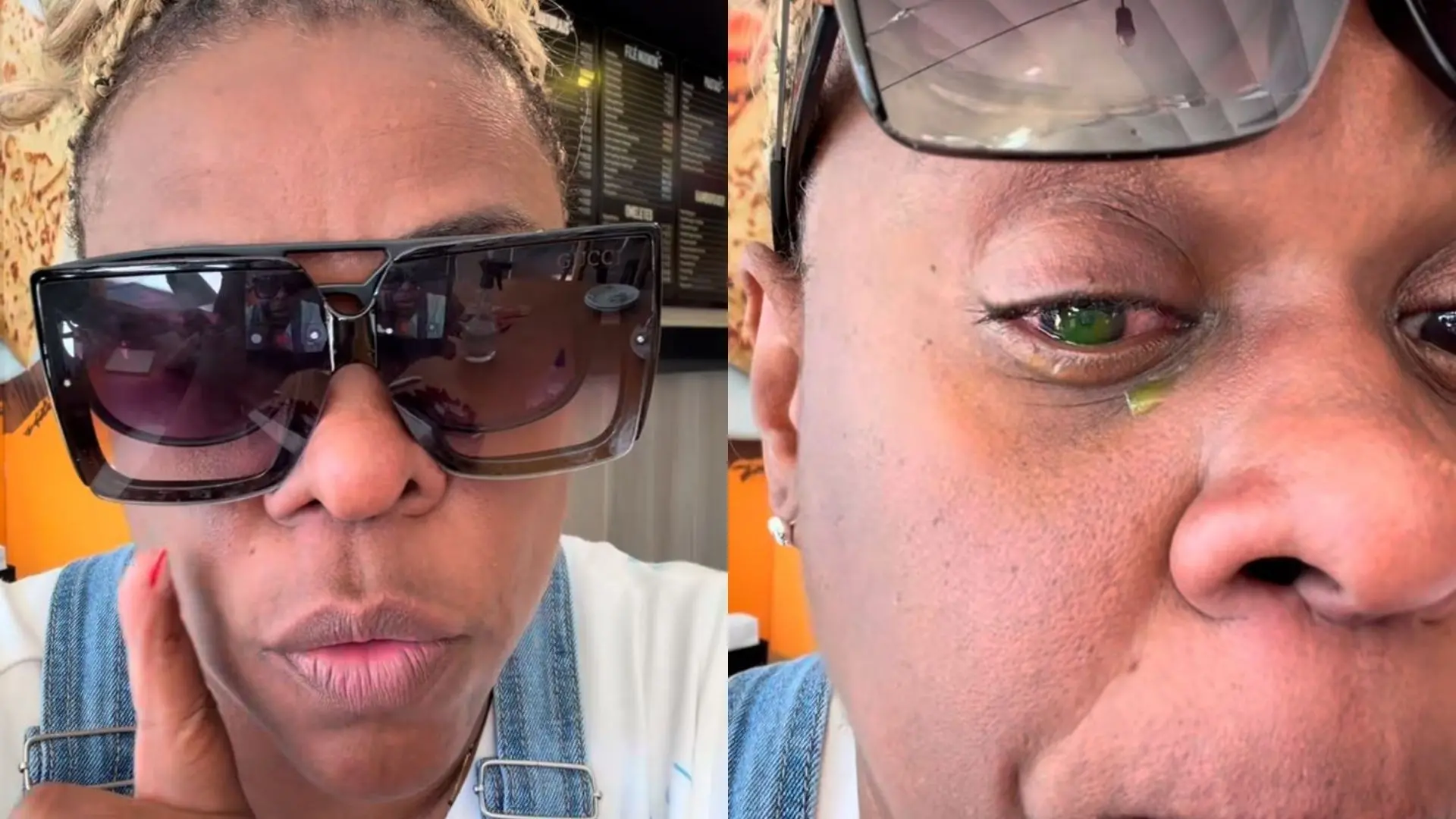 foto de atriz Cacau Protásio mostrando problema de saúde nos olhos por uso de pomada de cabelo.