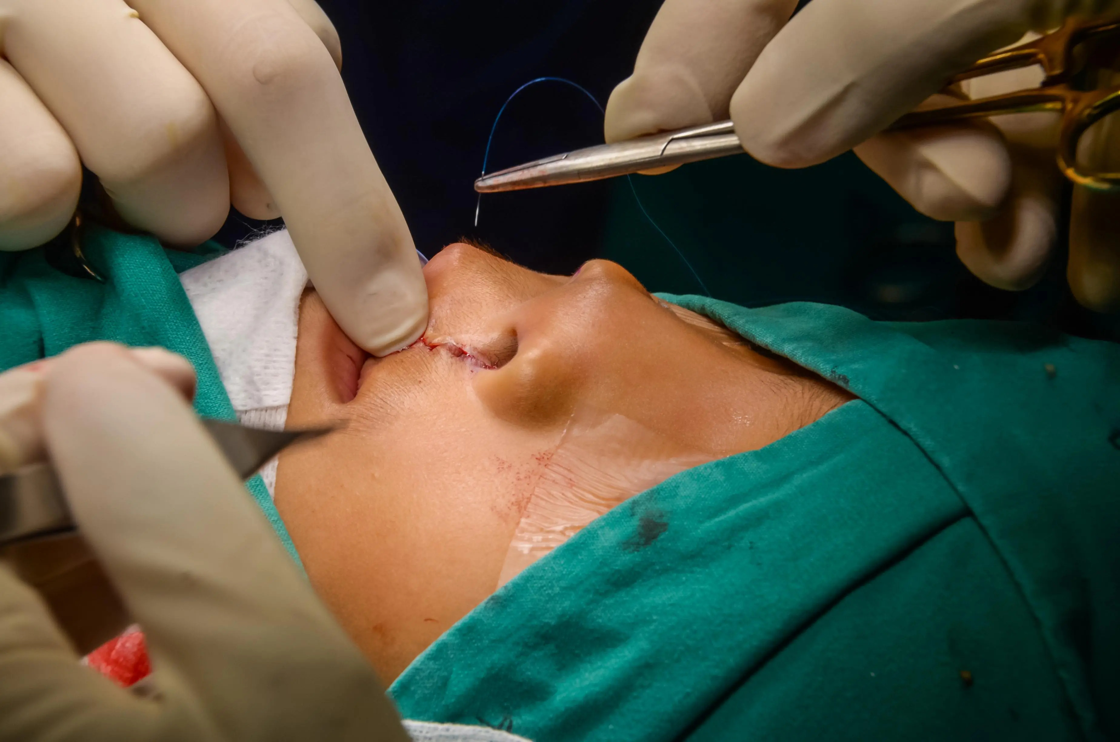 Imagem de criança com fissura de lábio e palato.