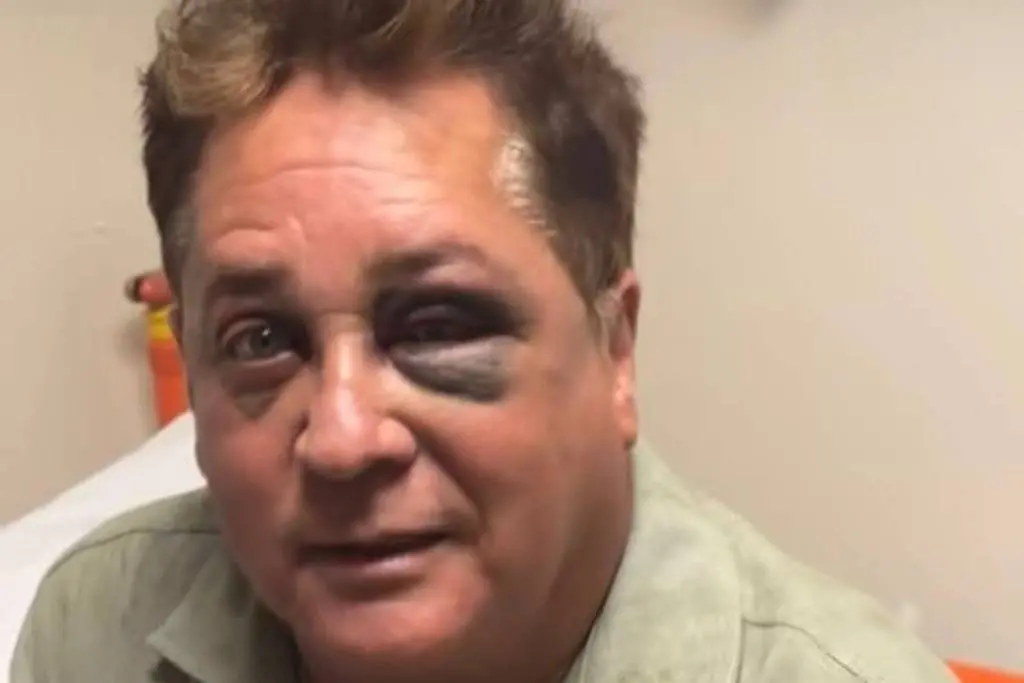 Em tom bem humorado, sertanejo mostrou aos fãs o olho machucado.