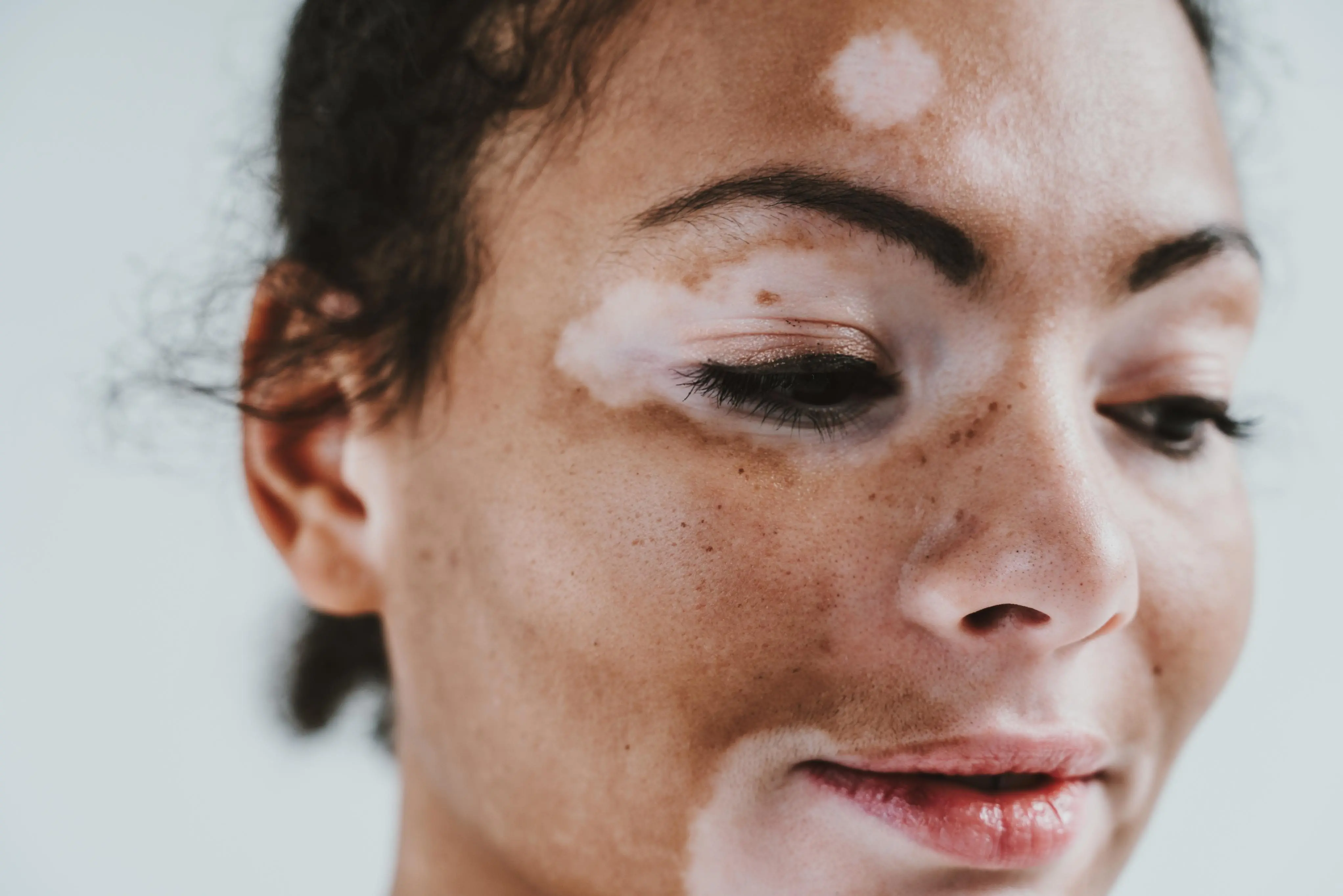 Imagem de uma mulher com vitiligo para ilustrar matéria sobre o tema.