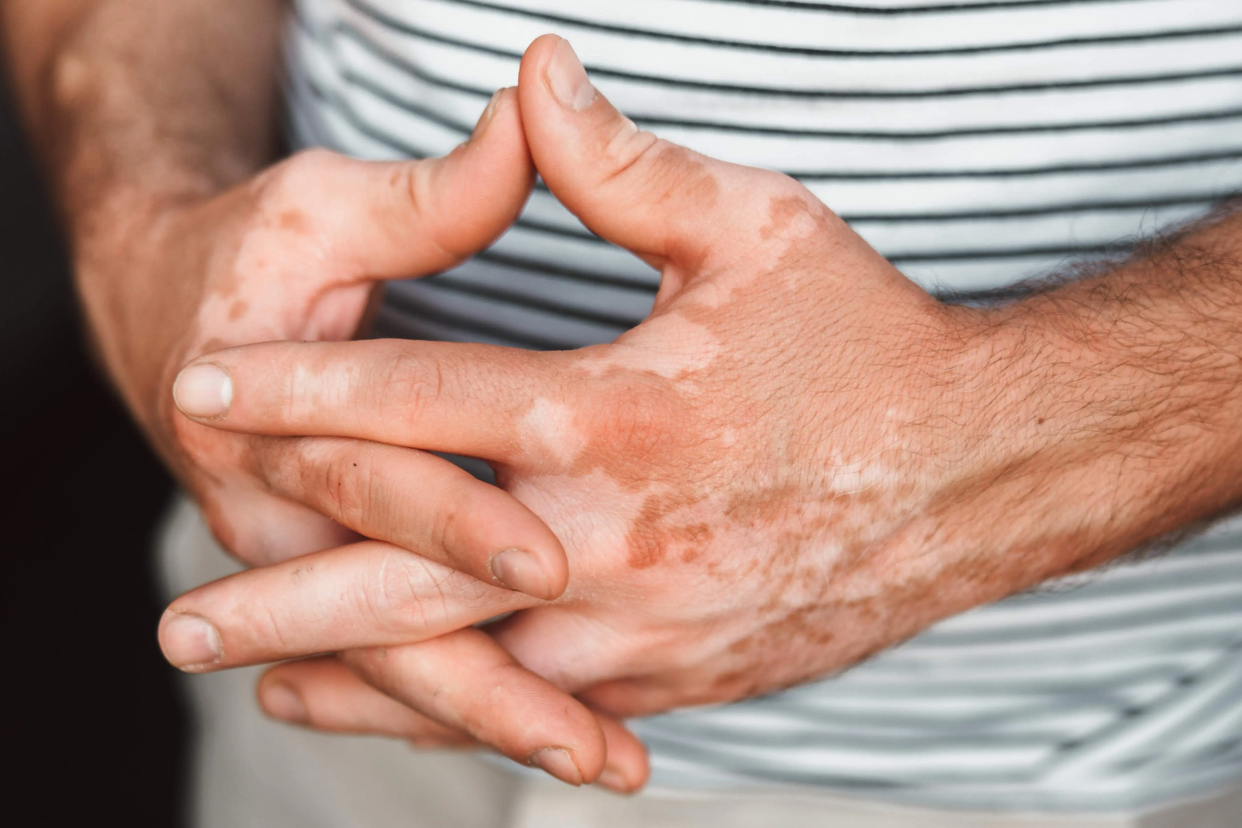 Imagem de uma mão com manchas de vitiligo.