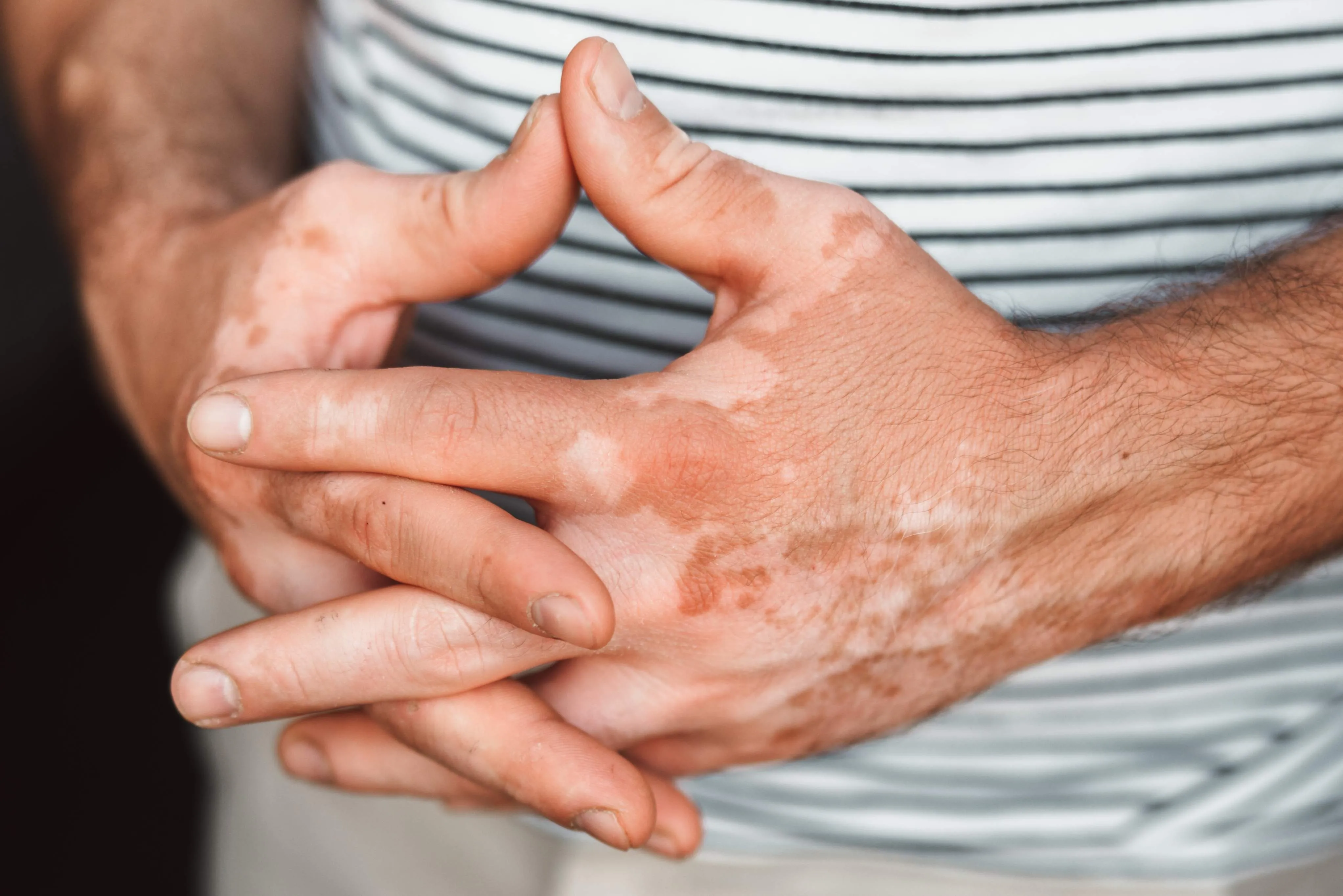 Com a condição, os pacientes registram a perda da cor natural da pele.