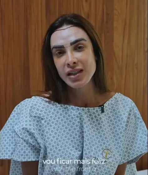 Imagem da notícia Nicole Bahls realiza transplante capilar sem raspagem e surpreende seguidores: 'rosto mais feminino'