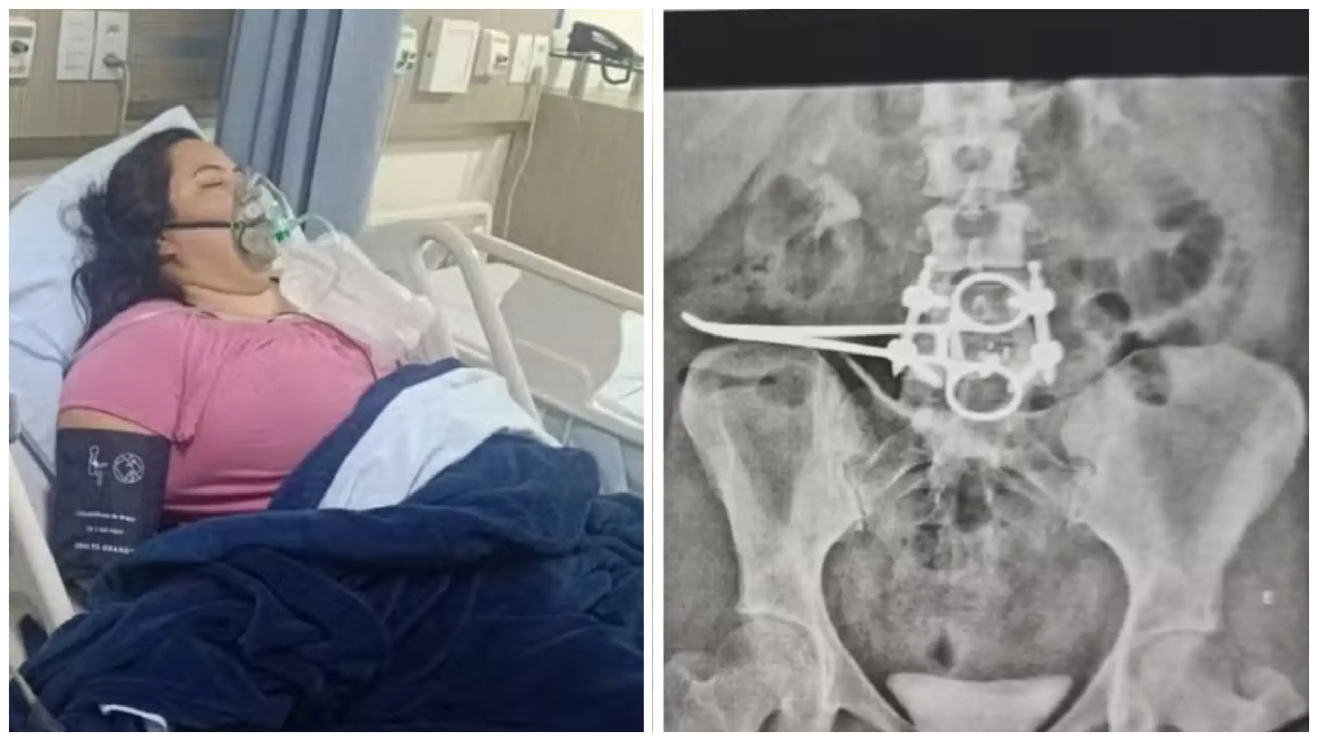Imagem da notícia Pinça cirúrgica de 18 centímetros é esquecida em paciente após procedimento