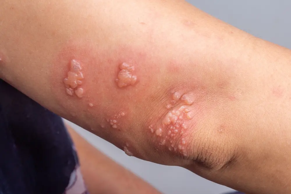 Imagem da notícia Quanto custa a vacina contra herpes-zóster? Veja lista de valores e onde se vacinar em Fortaleza
