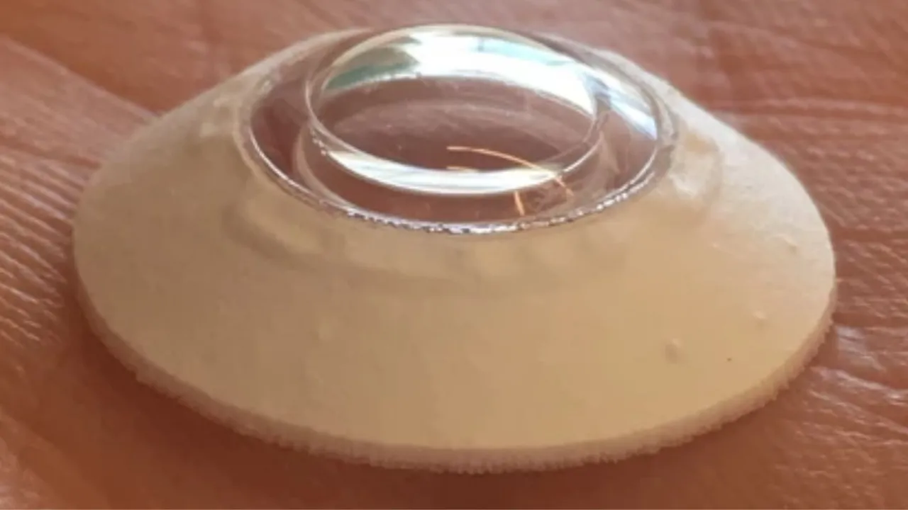 A CorNeat KPro é a primeira córnea artificial que se integra completamente com a parede do olho sem depender de tecido de doador