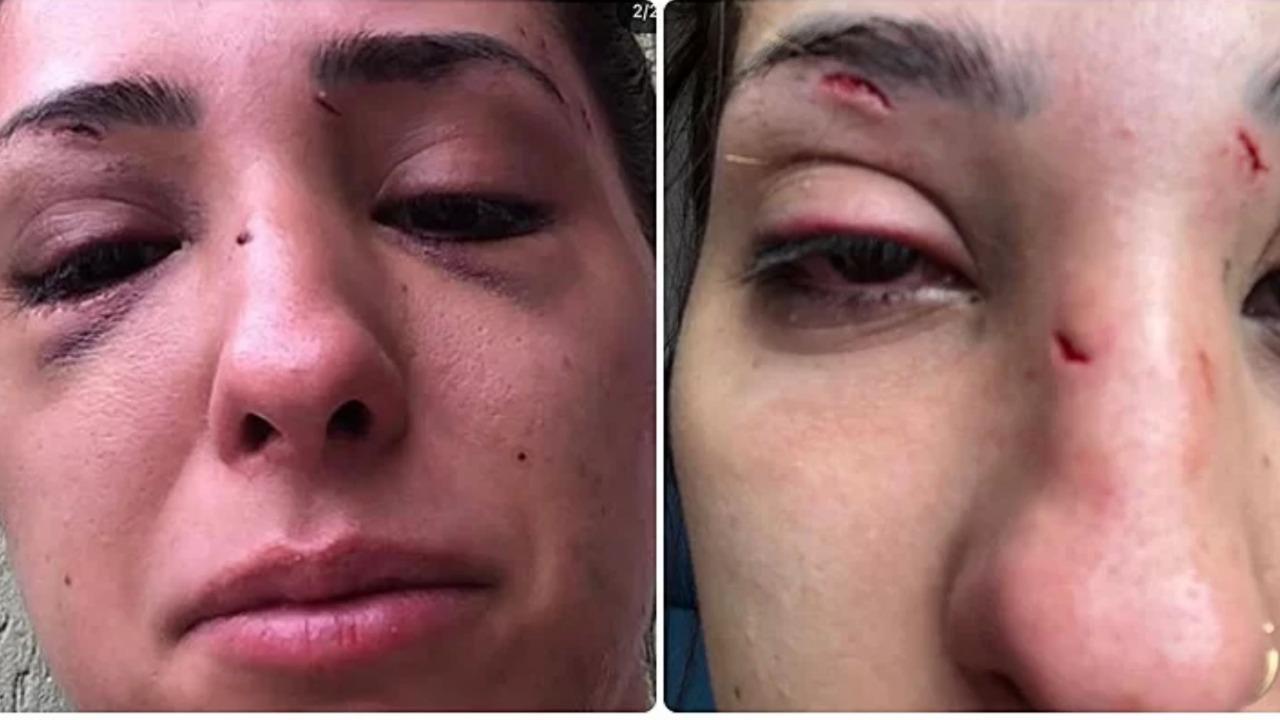 Fotos da jovem Gabriela Casellato com o rosto machucado após ser agredida pelo ex-namorado em São Paulo