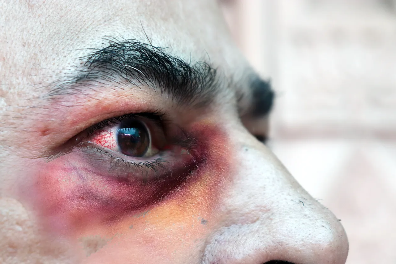 Segundo infectologistas, alguns dos sintomas comuns afetam os olhos dos pacientes