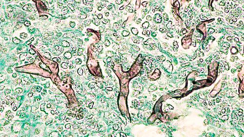 Infecção Fúngica - Mucormicose: Hifas amplas e não septadas de ângulo amplo do fungo Mucor, proveniente dos seios paranasais de um paciente com diabetes mellitus não controlado. Lâmina de histologia corada com GMS.