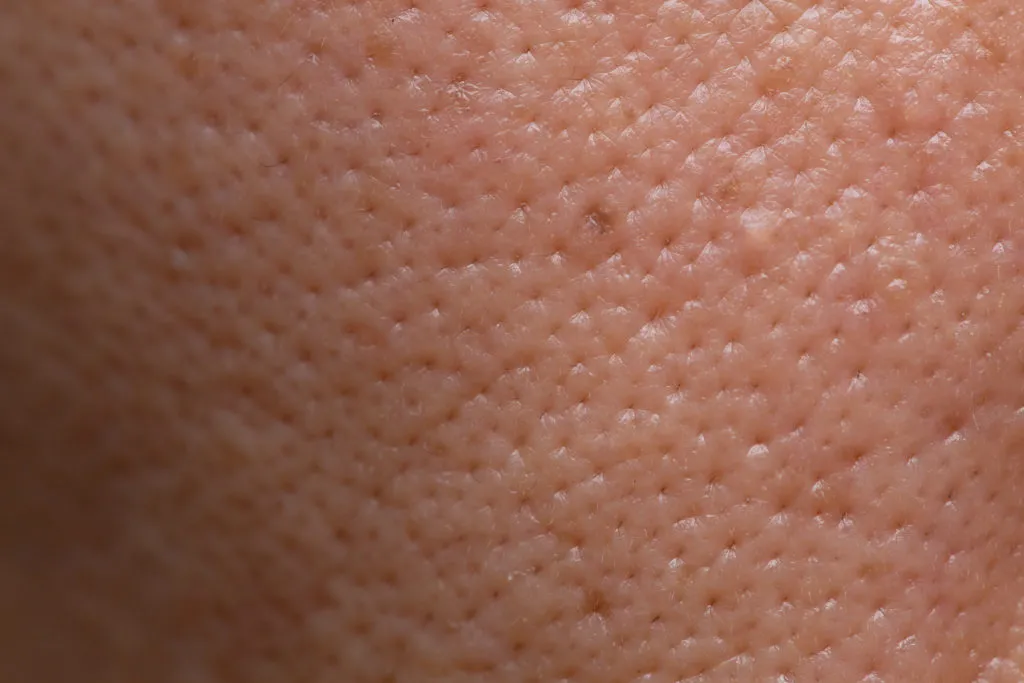 Aspecto da pele oleosa.