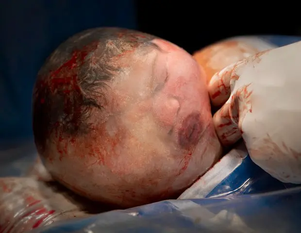 Bebê Noah Gabriel ainda em saco amniótico