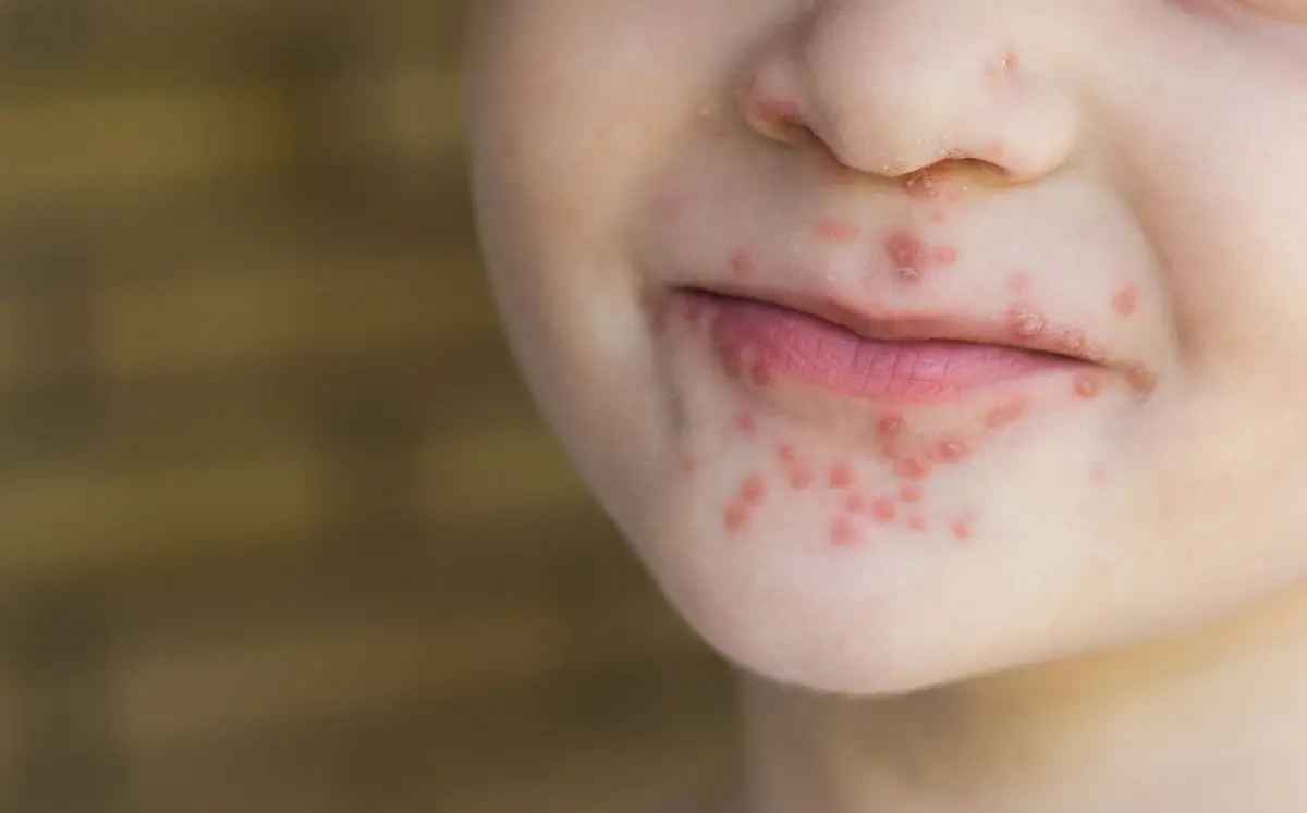 Bolhas ao redor de boca de criança com doença mão-pé-boca