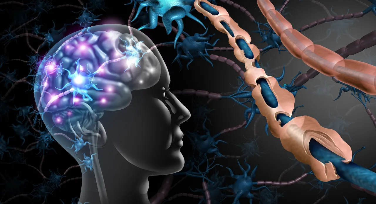 O sistema imunobiológico ataca a bainha de mielina responsáveis por proteger os neurônios do cérebro e da medula espinhal