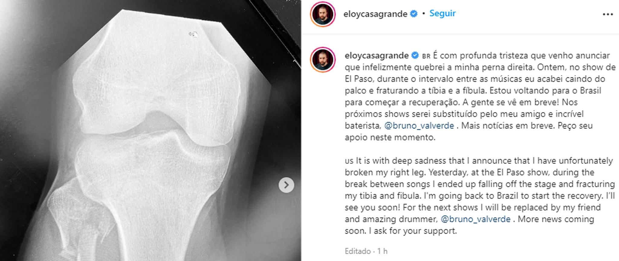 Publicação de Eloy Casagrande no Instagram sobre perna quebrada em show