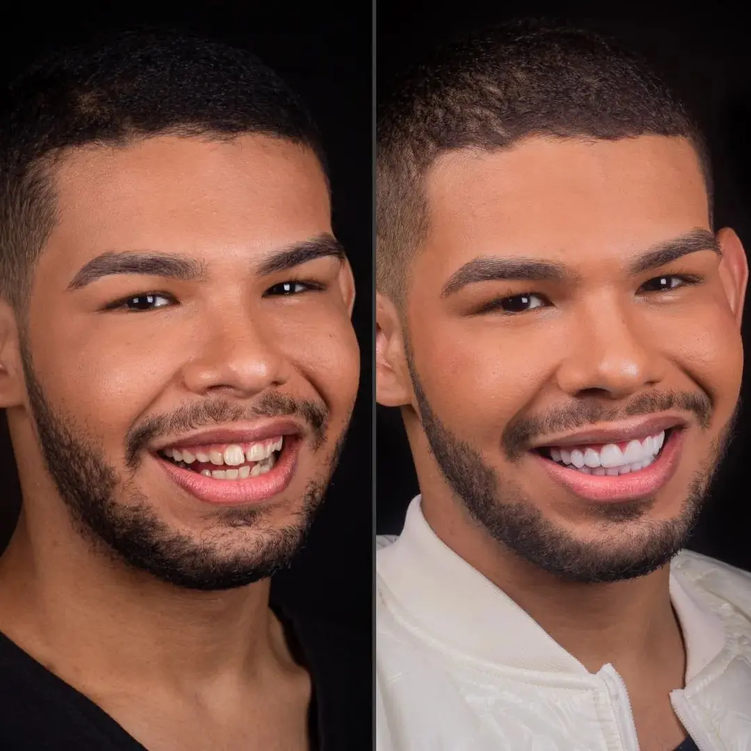 Antes e depois do vyni