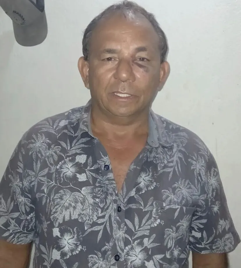 Parlamentar divulgou nas redes foto do hematoma no rosto