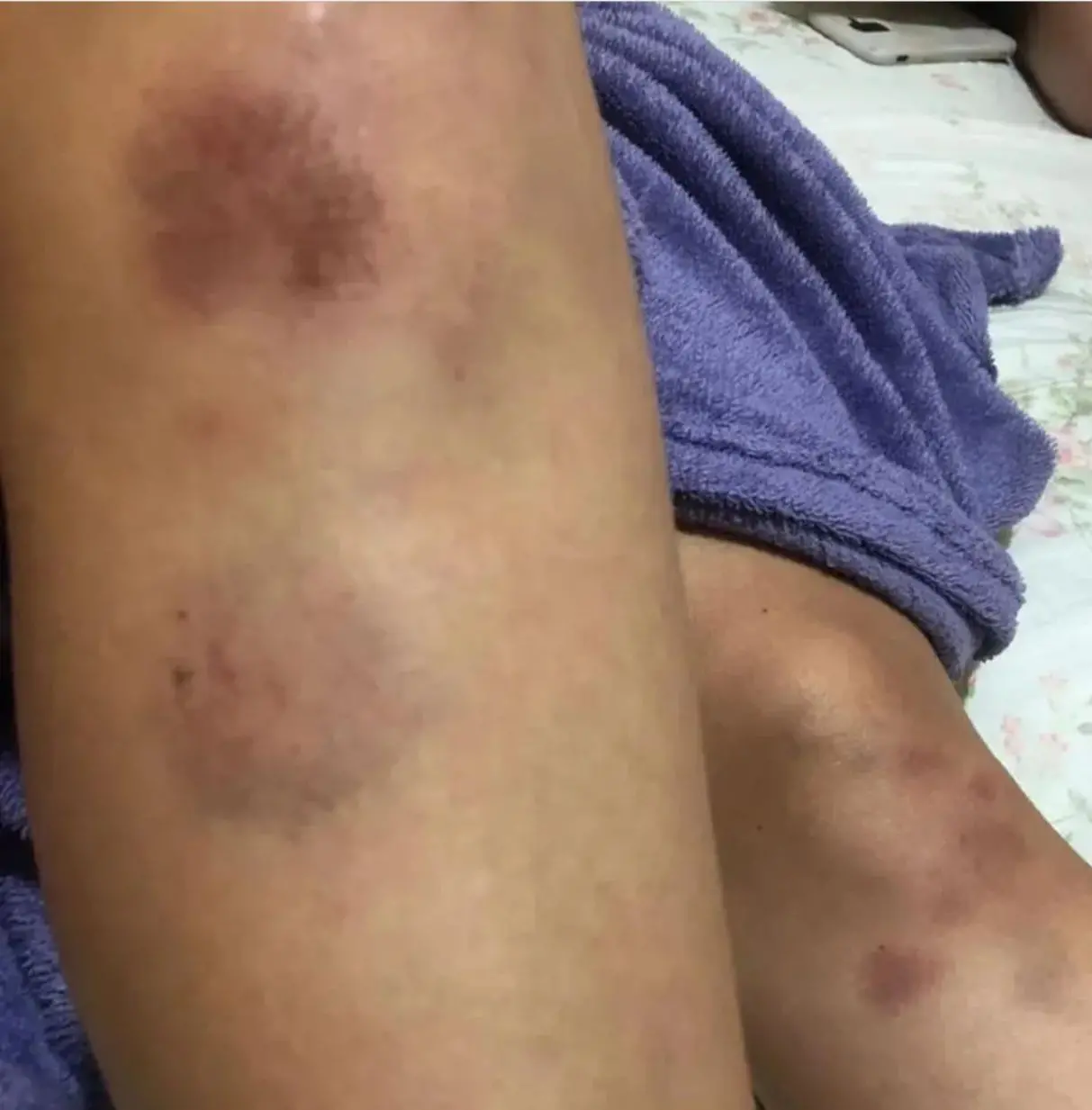 Vítima denunciou agressões pelas redes sociais e mostrou ferimentos e hematomas