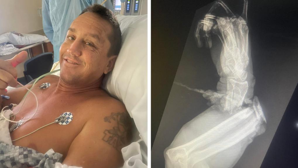 Montagem com imagens de Greg Graziani internado em hospital após ser atacado por jacaré ao lado de radiografia do antebraço machucado após o episódio