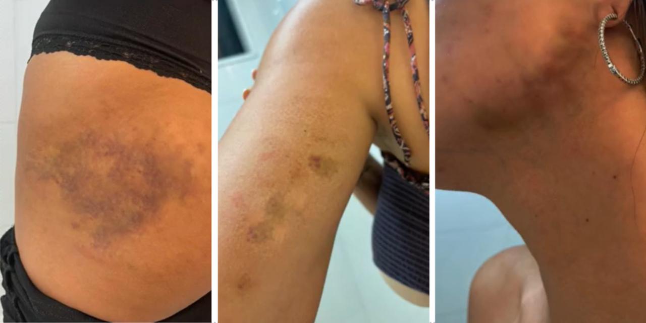 Montagem com fotos de hematomas em mulher que denuncia agressões de Thiago Brennand