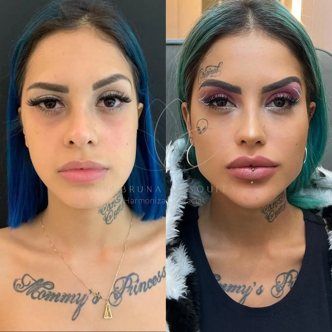 Harmonização facial Tati Zaqui