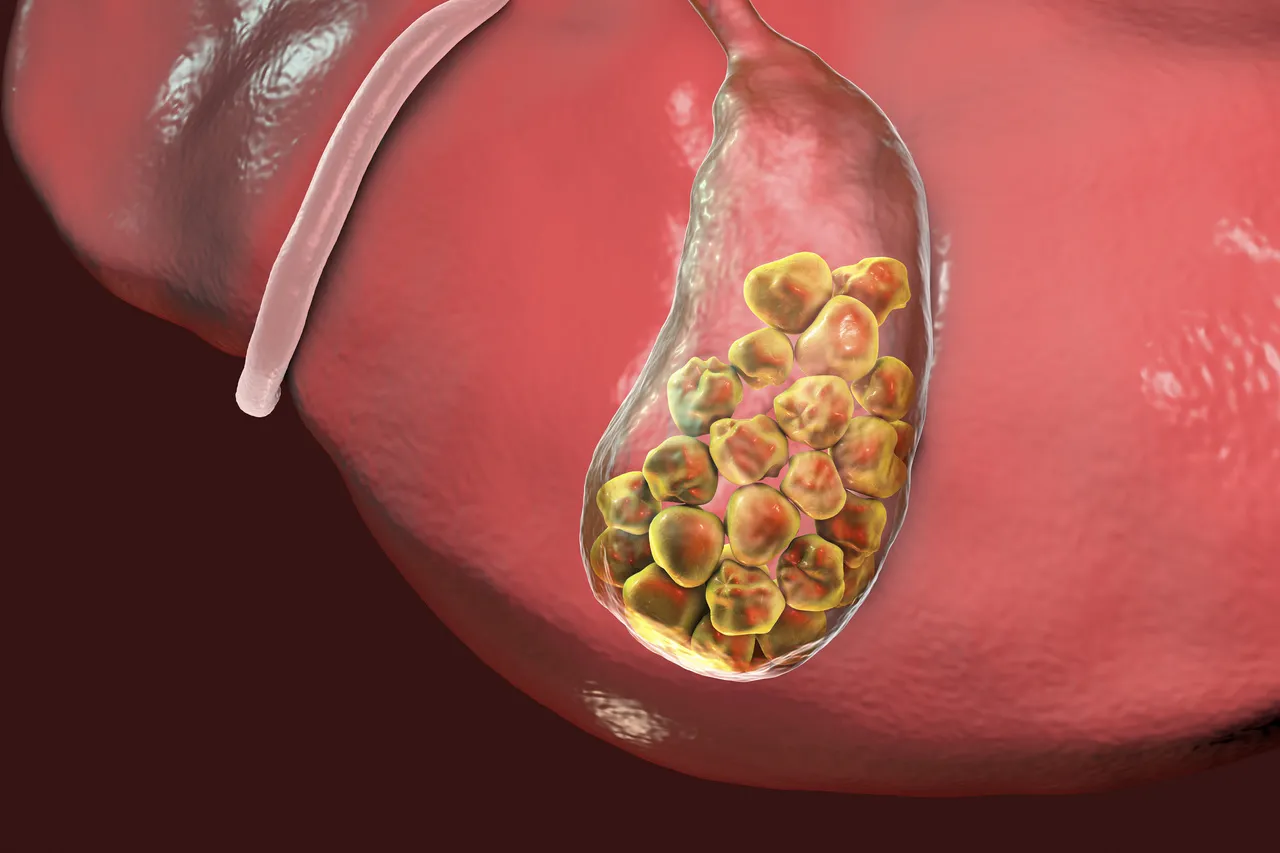 As pedras podem se alocar na vesícula ou no canal que leva a bile até o intestino