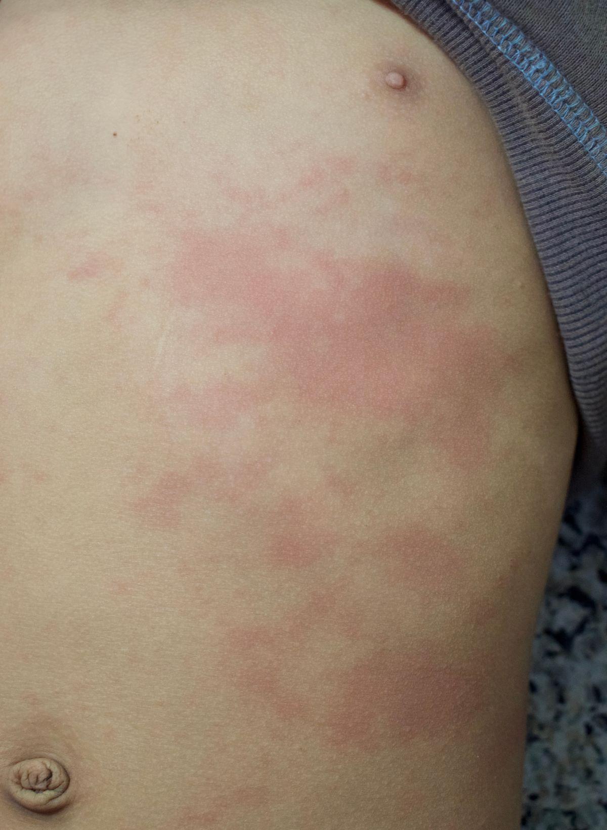 Manchas de chikungunuya na pele de pessoa