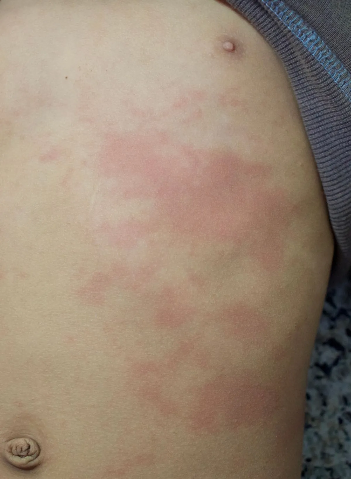 A chikungunya causa manchas pelo corpo