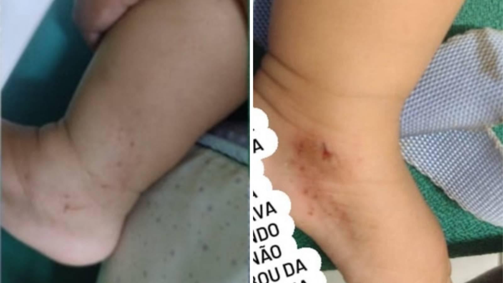 Montagem mostra hematomas e escoriações em bebê de que foi derrubado de motocicleta em movimento com a mãe em Sobral
