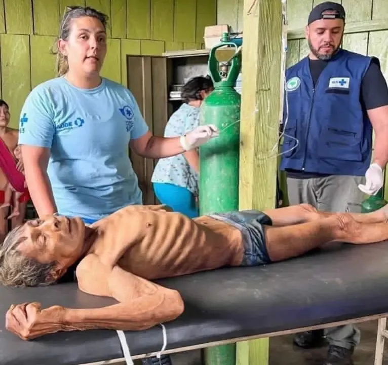 Imagens de indígenas adultos extremamente magros e de crianças visivelmente desnutridas mostram o tamanho da tragédia sobre os Yanomami