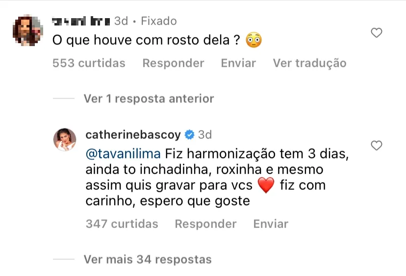 Catherine Bascoy confirmou que fez harmonização facial recentemente