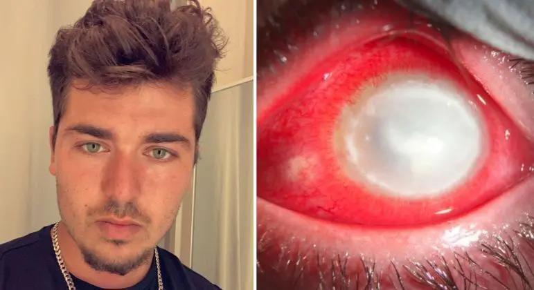 Montagem mostra imagem de Mike Krumholz antes de infecção ocular e olho direito infectado