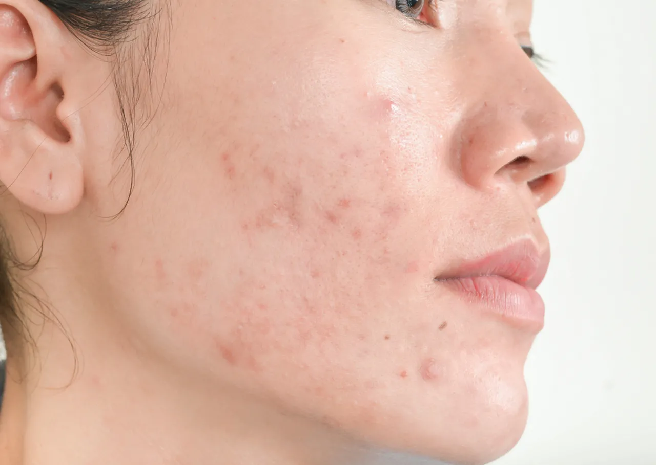 A acne é um dos efeitos colaterais dos implantes como o 'chip da beleza'